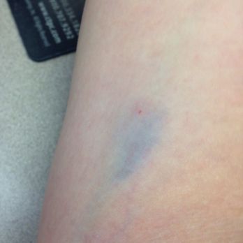 Labcorp - 30 minutes later this is what my arm looked like on the first vein attempt - Laboratory Testing Near Me - San Antonio, Texas Labcorp - 30 minutes later this is what my arm looked like on the first vein attempt - Laboratory Testing Near Me - San Antonio, Texas