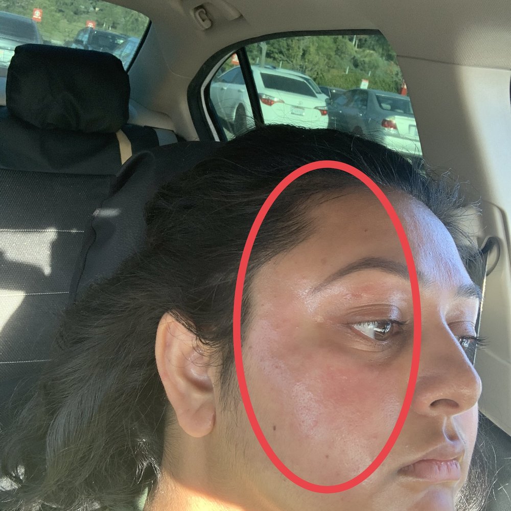 Obvious chemical burns with redness and inflammation. Obvious chemical burns with redness and inflammation.