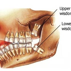 Western Pennsylvania Oral & Maxillofacial Surgery - Wisdom Teeth