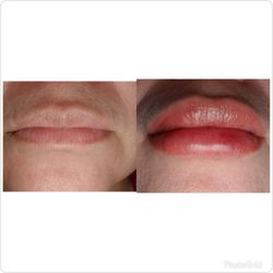 Empress Aesthetics - Juvederm fillers.