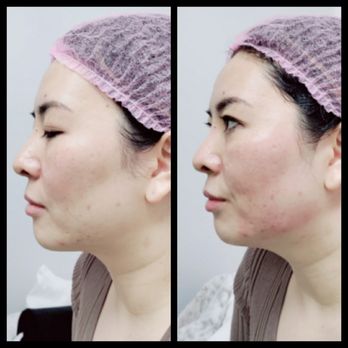 Black Sapphire Esthetics - Non Surgical Ultra Max HIFU Face Line Tightening - Eyelash Service Near Me - Henderson, Nevada Black Sapphire Esthetics - Non Surgical Ultra Max HIFU Face Line Tightening - Eyelash Service Near Me - Henderson, Nevada