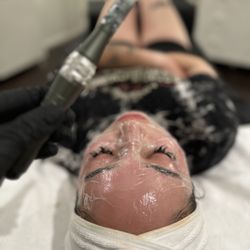 Elite Esthetics San Diego - Microneedling
