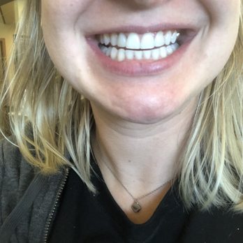 Molen Orthodontics - After: 20 minutes of Inna's and Dr. Ricks magic! My teeth match perfectly. THANK YOU, THANK YOU, THANK YOU, X1MILLION - Orthodontists Near Me - Auburn, Washington