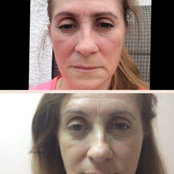 Leyla's Skin Care - This is a before and after of micro blading eyebrows by Leyla - Skin Care Near Me - Winnipeg, Manitoba Leyla's Skin Care - This is a before and after of micro blading eyebrows by Leyla - Skin Care Near Me - Winnipeg, Manitoba