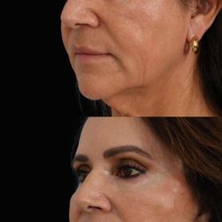 Advanced Facial Plastic Surgery Center - Face Lift + CO2 Laser