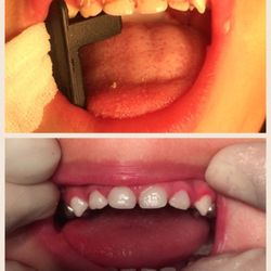 Danny Nguyen, DDS, MS - Typical severe decay on upper anterior primary teeth were restored by using strip crown technique.