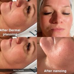 On The Brite Side of Skin - Had my very first dermal, planing and nano micro needling Christina is so knowledgeable and Her products and procedures.