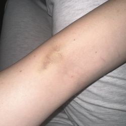 Quest Diagnostics - That was a terrible experience, the staff here really doesn't know how to do their job, my arm is blue and yellow and it's getting bigger.