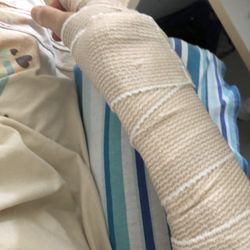 CareNow Urgent Care - South Congress - My broken arm in a splint from CareNow Urgent Care professional team. Great job!