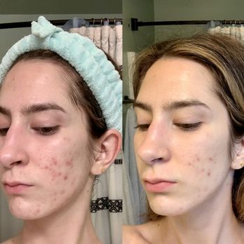 The Skin Bar - Nano peel before and less than 48hrs after - Skin Care Near Me - Covington, Louisiana The Skin Bar - Nano peel before and less than 48hrs after - Skin Care Near Me - Covington, Louisiana