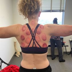 We provide therapeutic cupping