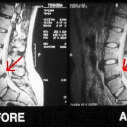 We have the experience to diagnose and treat disc conditions correctly and effectively.
