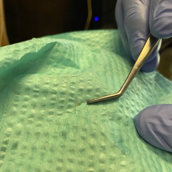 Oaxaca, Ong, Jensen, & Maeda - The pulp to my tooth - dr Ong took it out in 1 piece - General Dentistry Near Me - Seal Beach, California Oaxaca, Ong, Jensen, & Maeda - The pulp to my tooth - dr Ong took it out in 1 piece - General Dentistry Near Me - Seal Beach, California
