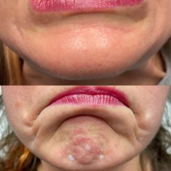 Excellence Medical Spa - Botox before and after