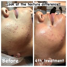LED light therapy - acne treatment LED light therapy - acne treatment