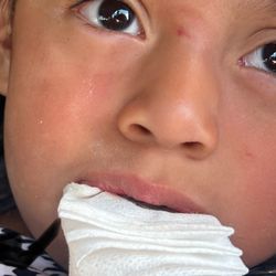 Western Dental & Orthodontics - Mask mark on my daughter nose.