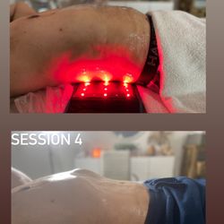 Bodiesbyyazmin - Fibrosis treatment