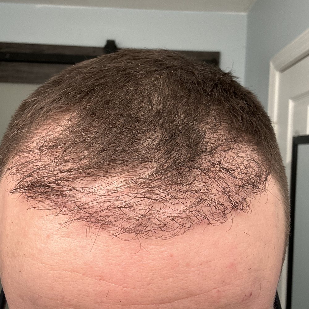 Robotic Hair RX - Hair Loss Centers Near Me - Tempe, Arizona Robotic Hair RX - Hair Loss Centers Near Me - Tempe, Arizona
