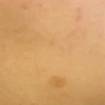 Skin Solutions - After laser treatment - Skin Care Near Me - Flushing, New York Skin Solutions - After laser treatment - Skin Care Near Me - Flushing, New York