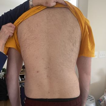 Milan Laser Hair Removal - They were paid to do  his back and shoulders.,All of it is still there. - Laser Hair Removal Near Me - Durham, North Carolina