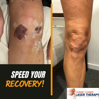 Healios Laser Therapy - Physical Therapy Near Me - Solana Beach, California Healios Laser Therapy - Physical Therapy Near Me - Solana Beach, California
