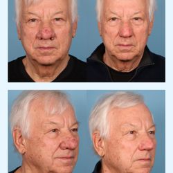 Douglas Sidle, MD - Northwestern Medicine - Rhinophyma, Before & After.