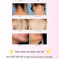 Saverae Belle Laser Med Spa - With results this great, WHY WAIT!!! Start your laser journey today! Book now!