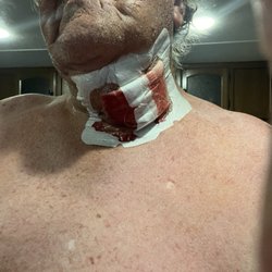 Methodist Texsan Hospital - This is my bandage after two hours of being discharged from the hospital. It's soon fell off, exposing the one and massive swelling.