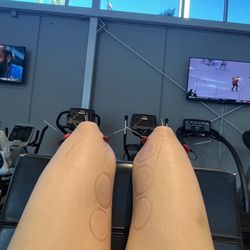 Athleticare Physical Therapy & Sports Performance - Dry needling and cupping to alleviate spasms and tight facia that compresses my nerves