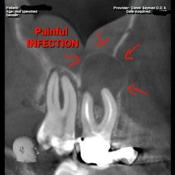Danni Sayman, DDS MS - Elite Endodontics - Painful infection above tooth #3. The tooth I came in for & was referred for, but ANOTHER  TOOTH WAS TREATED W/O MY CONSENT.
