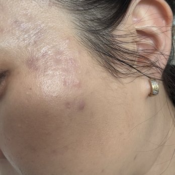 Acne Treatment SF - Skin Care Near Me - San Francisco, California Acne Treatment SF - Skin Care Near Me - San Francisco, California