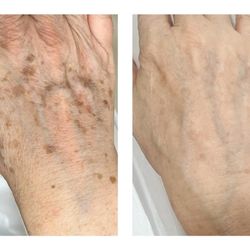 Bellezza Moderna Aesthetics - Hand rejuvenation. 2 IPL treatments.