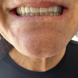 Blash Dentistry - Excellent job with my upper front teeth