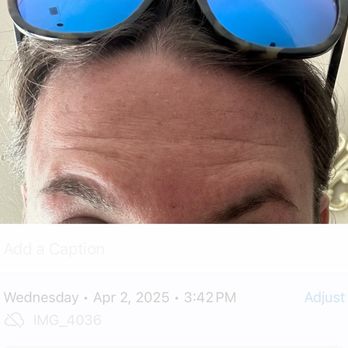 Artistik Beauty - 2 weeks after 40 units of Botox - Medical Spas Near Me - Winter Park, Florida Artistik Beauty - 2 weeks after 40 units of Botox - Medical Spas Near Me - Winter Park, Florida