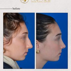 Visage Facial Plastic Surgery - A more feminine nose.