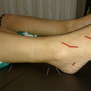Modern Acupuncture - Broken pinkie toe - Acupuncture Near Me - Sparks, Nevada Modern Acupuncture - Broken pinkie toe - Acupuncture Near Me - Sparks, Nevada
