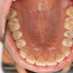 Alex Jhang, DDS - Invisalign Treated Lower Teeth