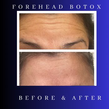 SF Aesthetics MedSpa - Erase horizontal Forehead with our Aesthetic Treatments - Medical Spas Near Me - Bourbonnais, Illinois