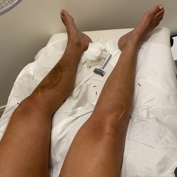 NuvoMed - Acupuncture for detox. Acupuncture for stress. Acupuncture for insomnia. ACUPUNCTURE NUVOMED MONTRÉAL - Acupuncture Near Me - Montreal, Quebec NuvoMed - Acupuncture for detox. Acupuncture for stress. Acupuncture for insomnia. ACUPUNCTURE NUVOMED MONTRÉAL - Acupuncture Near Me - Montreal, Quebec