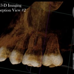 Glendale Endodontics & Microsurgery - David Abdelmalak,DDS - Second view of a Cone Beam 3-D image of Internal Root Resorption