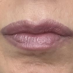 Breazeale Clinic For Plastic Surgery - After Lip Flip