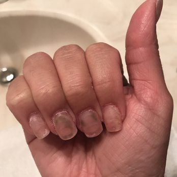 Cool Nail & Spa - Results after 1-1/2 week!! Omgggg ewwwww terrible work - Hair Removal Near Me - Saint Peters, Missouri