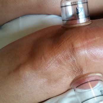 Found Balance Wellness - Knee injury Cupping Therapy - Massage Therapy Near Me Found Balance Wellness - Knee injury Cupping Therapy - Massage Therapy Near Me