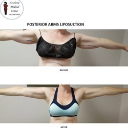 Aesthetic Medical Center - Posterior Arms Liposuction & Skin reduction/Brachioplasty (Arm Lift)