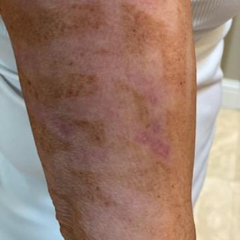 Lucent Aesthetic - #ipl #iplburn #drvalerieschneider #schneider #drschneider #lucentaesthetic #walnutcreek #walnutcreekca #mainstreet - Medical Spas Near Me - Walnut Creek, California Lucent Aesthetic - #ipl #iplburn #drvalerieschneider #schneider #drschneider #lucentaesthetic #walnutcreek #walnutcreekca #mainstreet - Medical Spas Near Me - Walnut Creek, California