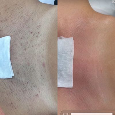 glutathione injections for skin lightening near me TOP 10 BEST Glutathione Injection in New York, NY - Updated 2026 - Quality  & Affordability