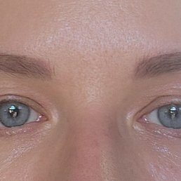 Upper eyelids 8 days after the procedure. Upper eyelids 8 days after the procedure.