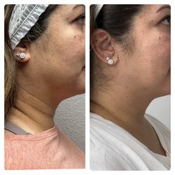 SkinRenew Laser Medical Center - Potenza MicroNeedling RF before and after neck area package of 3