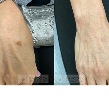 Dermatology Babcock - Brown spot treatment - Dermatologists Near Me - Atlanta, Georgia Dermatology Babcock - Brown spot treatment - Dermatologists Near Me - Atlanta, Georgia