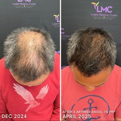 LMC - Laser Medical Clinic - PRP hair loss solution is LMC's specialty